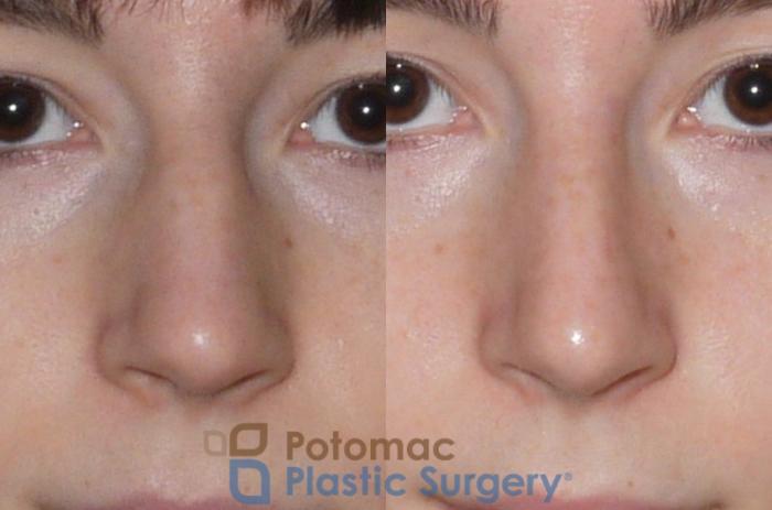 Before & After Rhinoplasty - Cosmetic Case 107 Front View in Washington DC & Arlington , DC