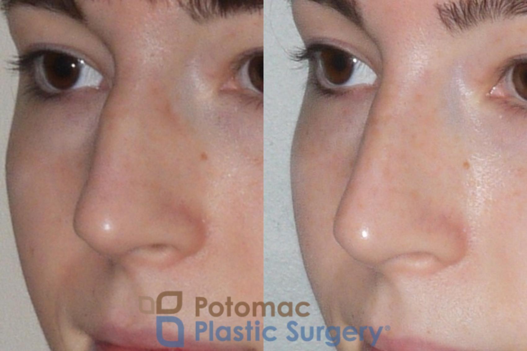 Before & After Rhinoplasty - Cosmetic Case 107 Left Oblique View in Washington DC & Arlington , DC