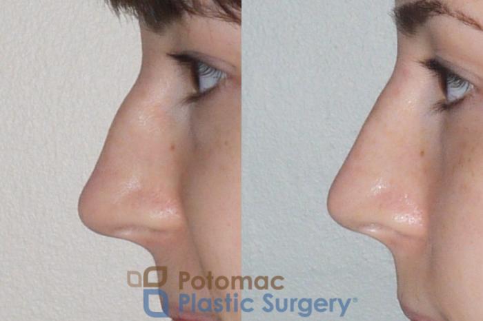 Before & After Rhinoplasty - Cosmetic Case 107 Left Side View in Washington DC & Arlington , DC