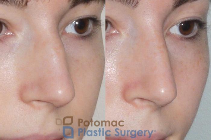 Before & After Rhinoplasty - Cosmetic Case 107 Right Oblique View in Washington DC & Arlington , DC