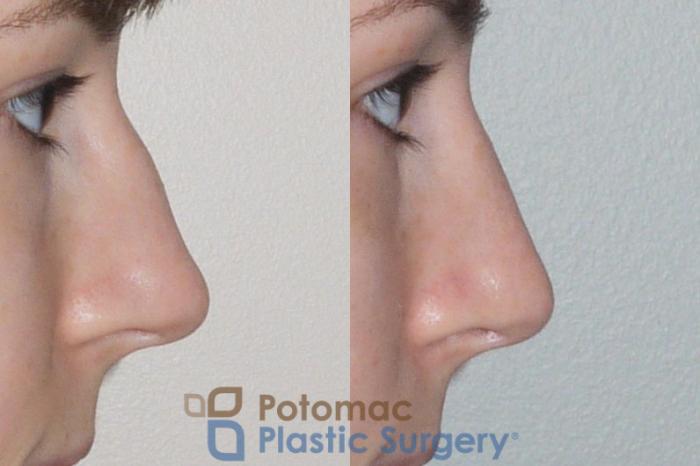 Before & After Rhinoplasty - Cosmetic Case 107 Right Side View in Washington DC & Arlington , DC