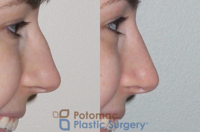 Before & After Rhinoplasty - Cosmetic Case 107 Right Side View #2 View in Washington DC & Arlington , DC