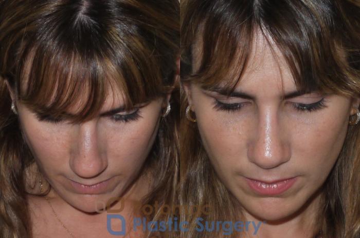 Before & After Rhinoplasty - Medical Case 108 Above View in Washington DC & Arlington , DC