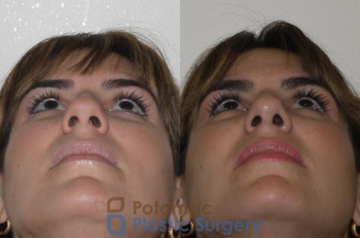 Before & After Rhinoplasty - Cosmetic Case 108 Below View in Washington DC & Arlington , DC