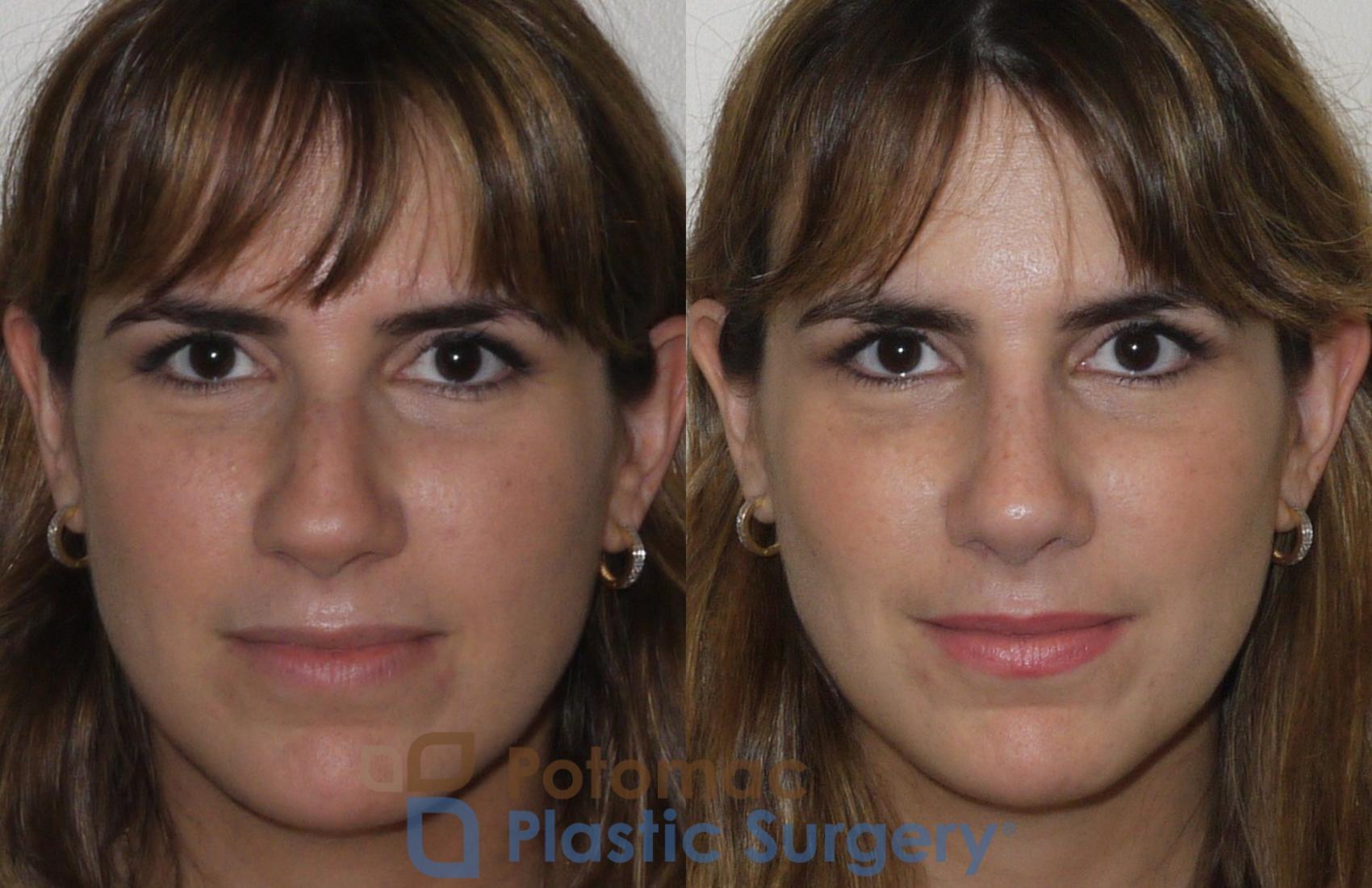 Before & After Rhinoplasty - Medical Case 108 Front View in Washington, DC