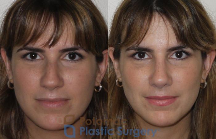 Before & After Rhinoplasty - Medical Case 108 Front View in Washington DC & Arlington , DC