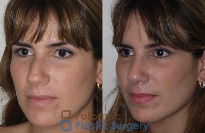 Before & After Rhinoplasty - Medical Case 108 Left Oblique View in Washington DC & Arlington , DC