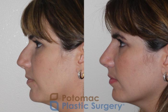 Before & After Rhinoplasty - Cosmetic Case 108 Left Side View in Washington DC & Arlington , DC