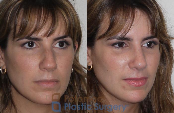 Before & After Rhinoplasty - Medical Case 108 Right Oblique View in Washington DC & Arlington , DC