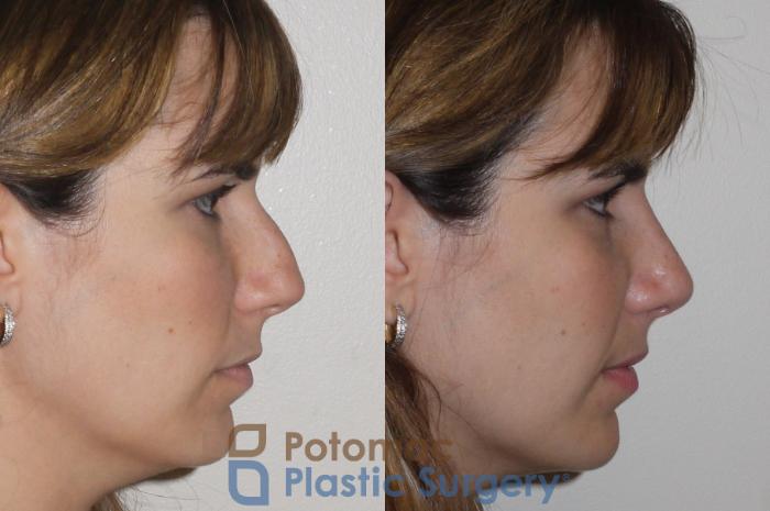 Before & After Rhinoplasty - Medical Case 108 Right Side View in Washington DC & Arlington , DC