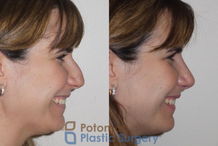 Before & After Rhinoplasty - Medical Case 108 Right Side View #2 View in Washington DC & Arlington , DC