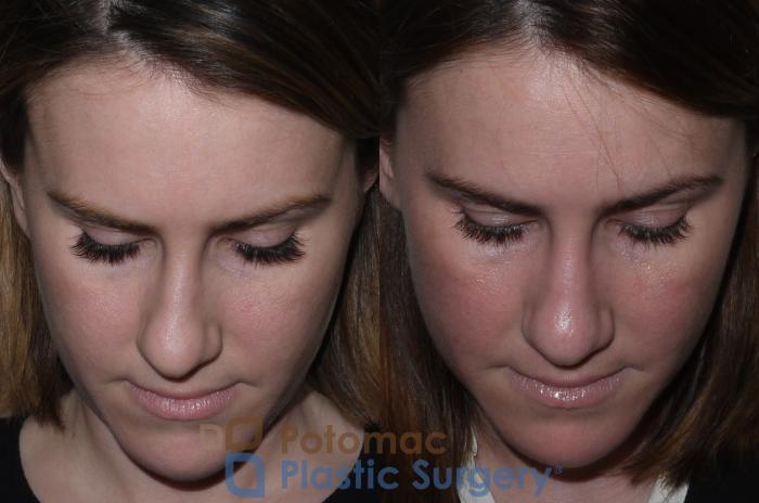 Before & After Rhinoplasty - Cosmetic Case 128 Above View in Washington DC & Arlington , DC