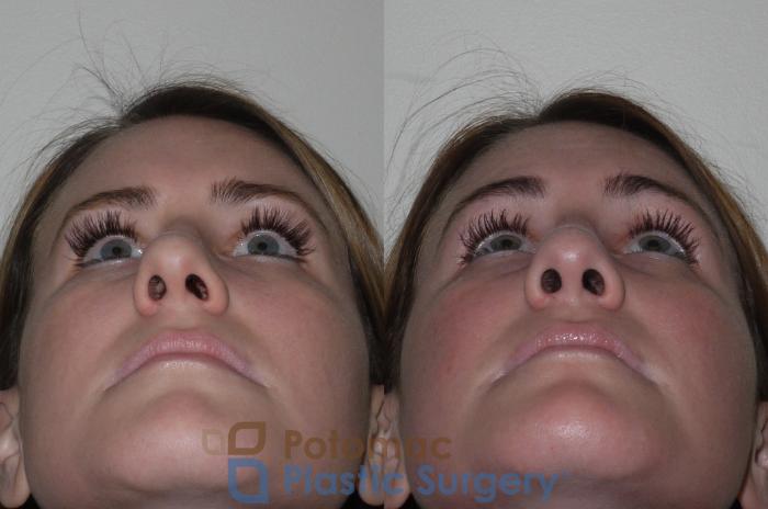 Before & After Rhinoplasty - Medical Case 128 Below View in Washington, DC