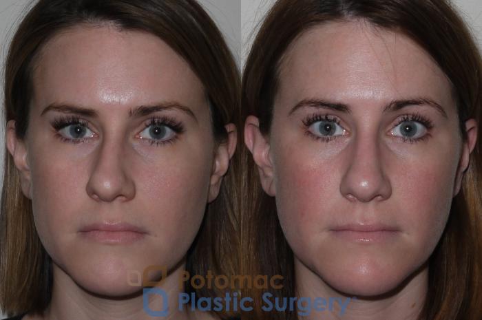 Before & After Rhinoplasty - Medical Case 128 Front View in Washington DC & Arlington , DC