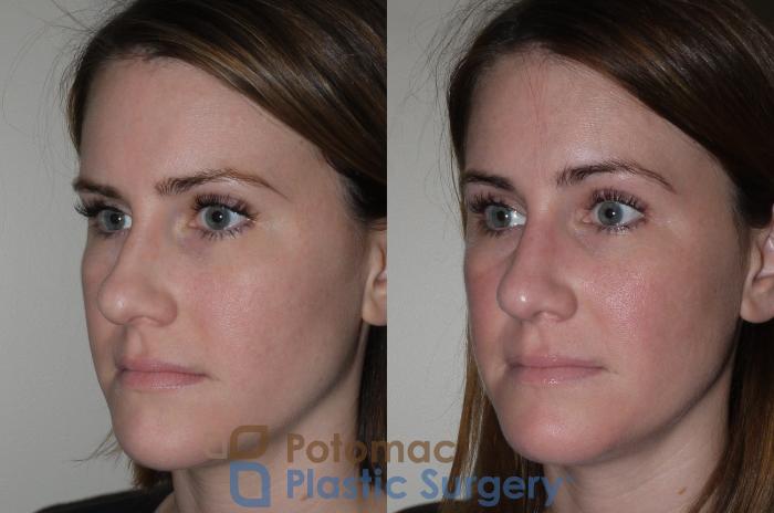 Before & After Rhinoplasty - Cosmetic Case 128 Left Oblique View in Washington DC & Arlington , DC