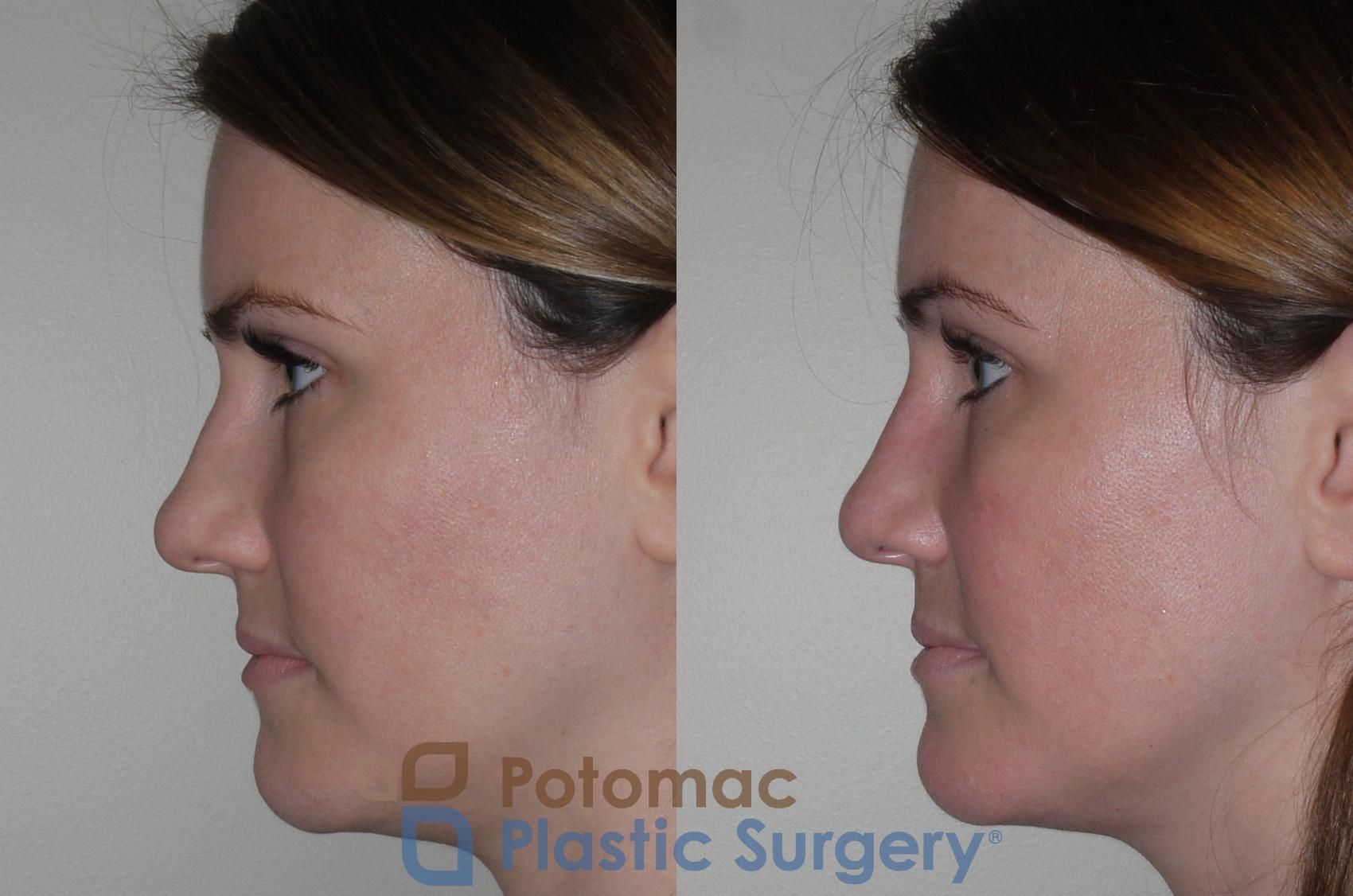 Before & After Rhinoplasty - Cosmetic Case 128 Left Side View in Washington DC & Arlington , DC