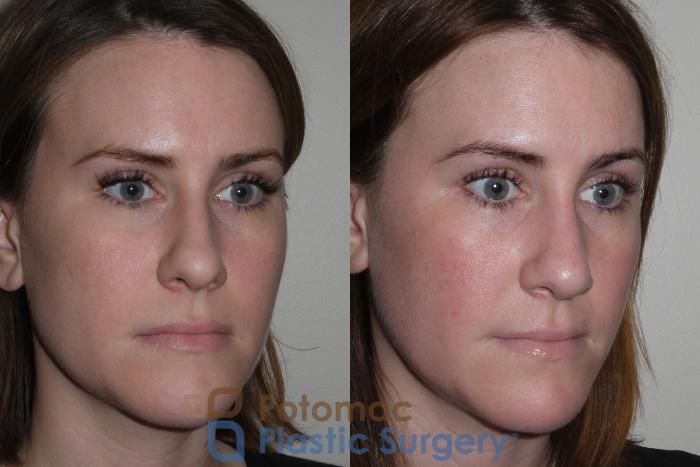 Before & After Rhinoplasty - Cosmetic Case 128 Right Oblique View in Washington DC & Arlington , DC