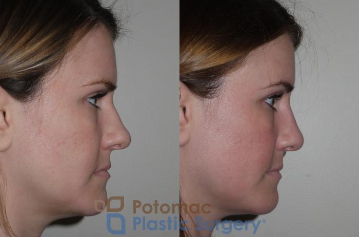 Before & After Rhinoplasty - Cosmetic Case 128 Right Side View in Washington DC & Arlington , DC