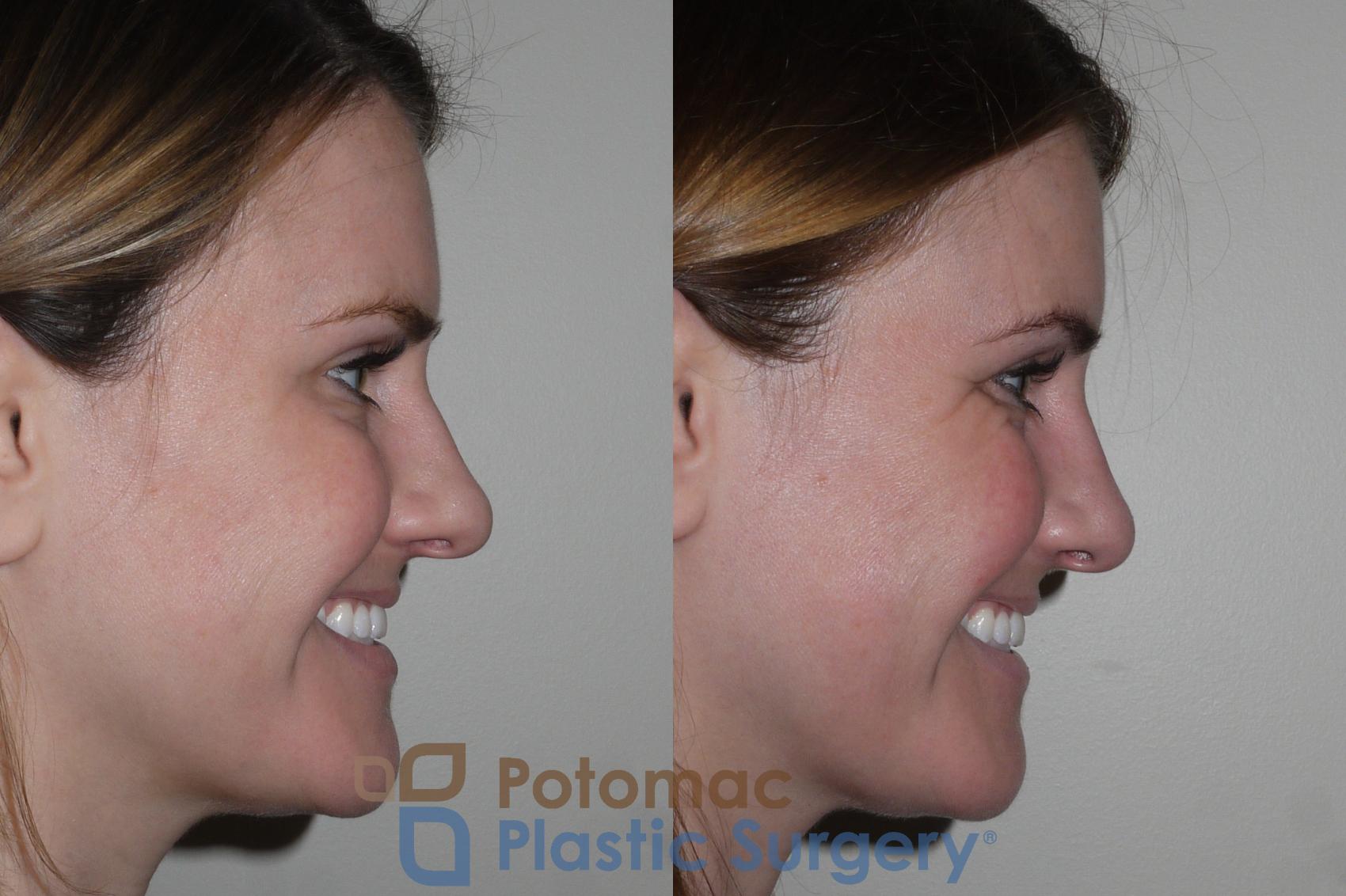 Before & After Rhinoplasty - Cosmetic Case 128 Right Side View #2 View in Washington DC & Arlington , DC