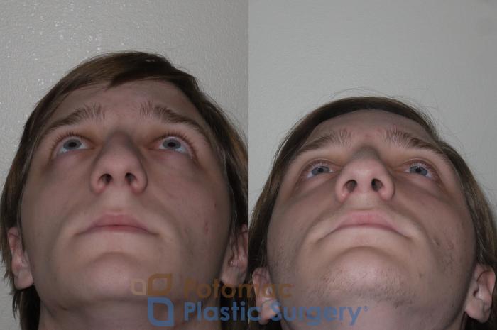 Before & After Rhinoplasty - Medical Case 130 Bottom View in Washington DC & Arlington , DC