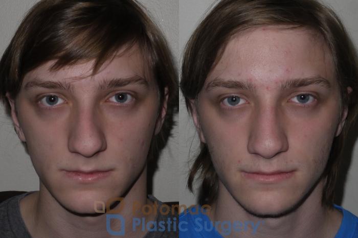 Before & After Rhinoplasty - Cosmetic Case 130 Front View in Washington DC & Arlington , DC