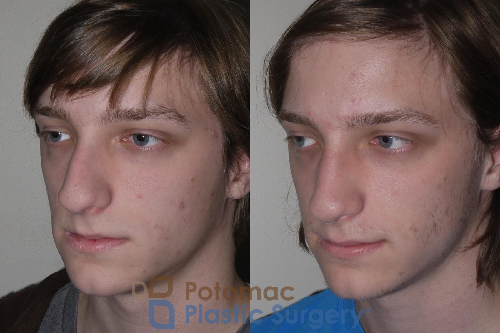 Before & After Rhinoplasty - Medical Case 130 Left Oblique View in Washington DC & Arlington , DC