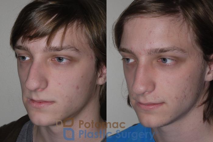 Before & After Rhinoplasty - Cosmetic Case 130 Left Oblique View in Washington DC & Arlington , DC