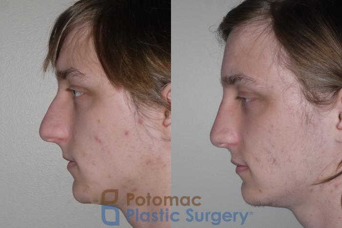 Before & After Rhinoplasty - Cosmetic Case 130 Left Side View in Washington DC & Arlington , DC