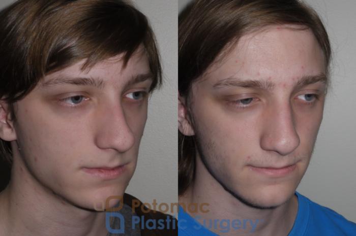 Before & After Rhinoplasty - Cosmetic Case 130 Right Oblique View in Washington DC & Arlington , DC