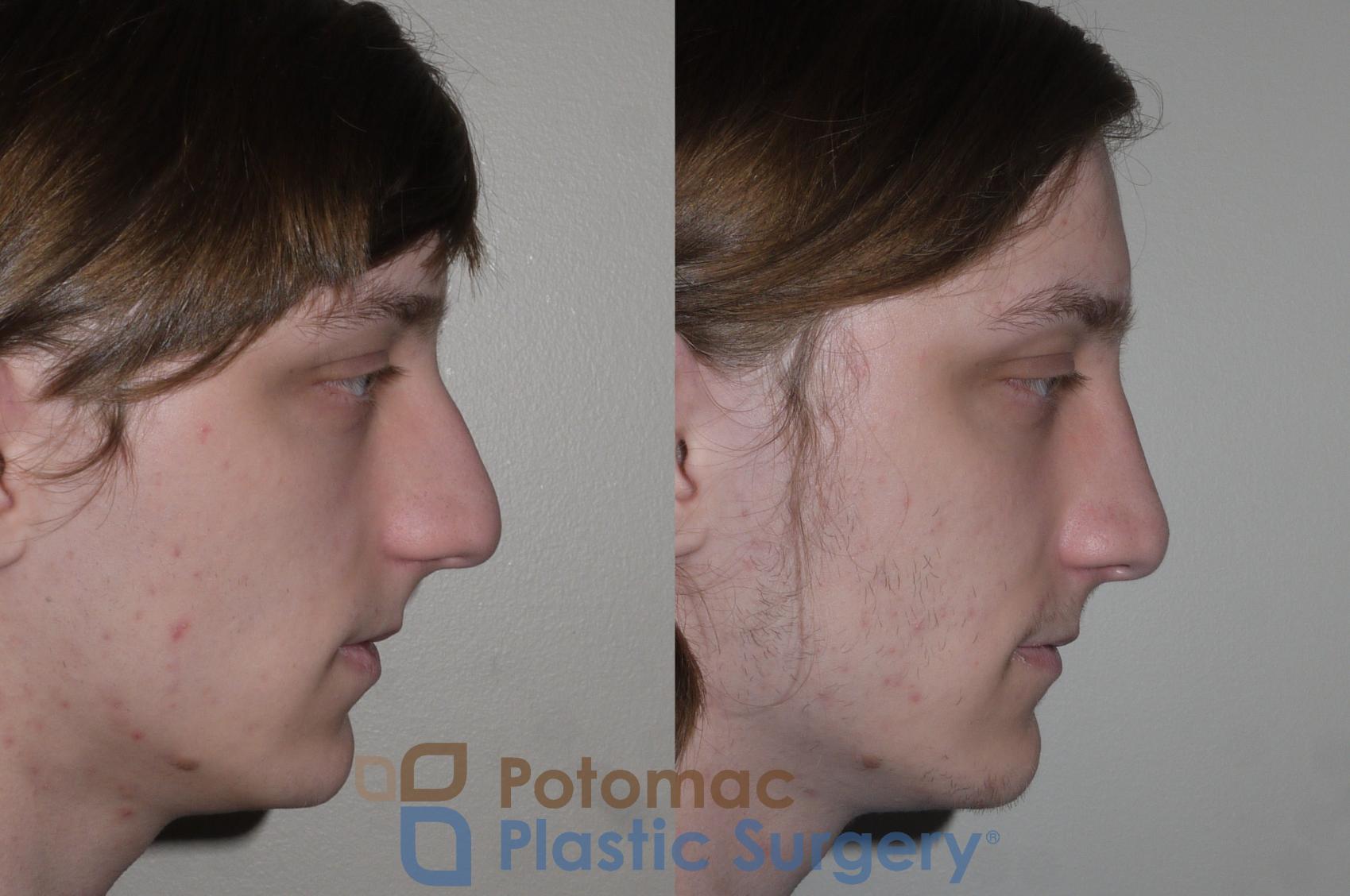 Before & After Rhinoplasty - Cosmetic Case 130 Right Side View in Washington DC & Arlington , DC