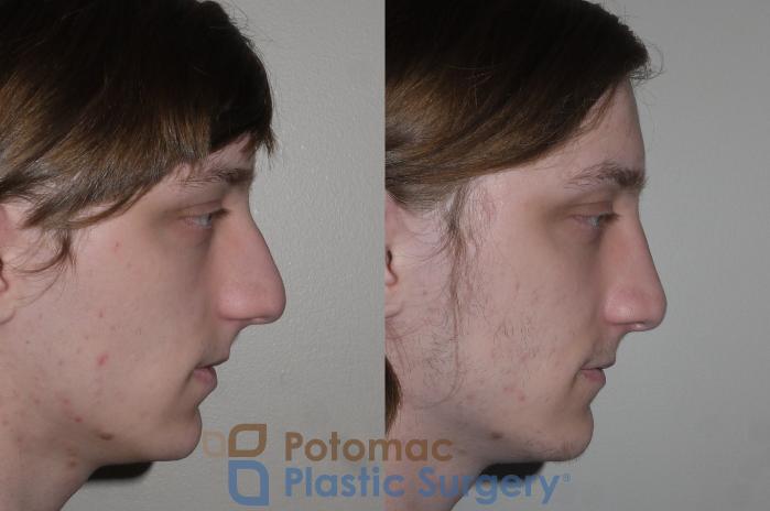Before & After Rhinoplasty - Medical Case 130 Right Side View in Washington DC & Arlington , DC