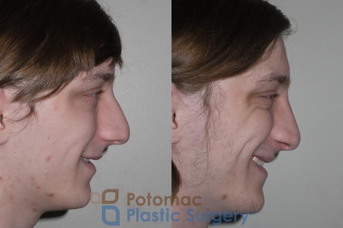 Before & After Rhinoplasty - Cosmetic Case 130 Right Side View #2 View in Washington DC & Arlington , DC