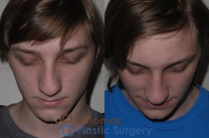 Before & After Rhinoplasty - Cosmetic Case 130 Top View in Washington DC & Arlington , DC