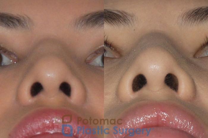 Before & After Rhinoplasty - Cosmetic Case 143 Bottom View in Washington DC & Arlington , DC
