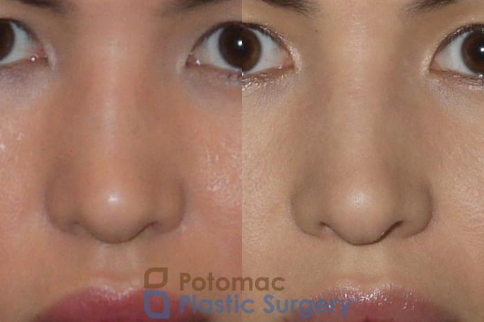 Before & After Rhinoplasty - Cosmetic Case 143 Front View in Washington DC & Arlington , DC