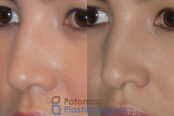 Before & After Rhinoplasty - Cosmetic Case 143 Left Oblique View in Washington DC & Arlington , DC