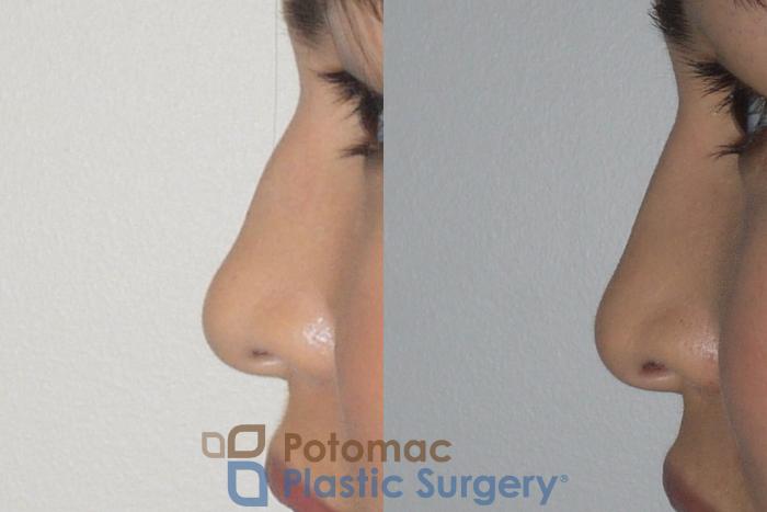 Before & After Rhinoplasty - Cosmetic Case 143 Left Side View in Washington DC & Arlington , DC