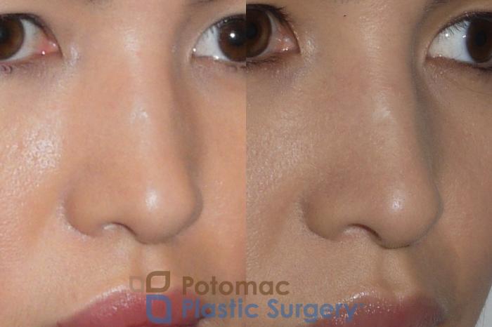 Before & After Rhinoplasty - Cosmetic Case 143 Right Oblique View in Washington DC & Arlington , DC