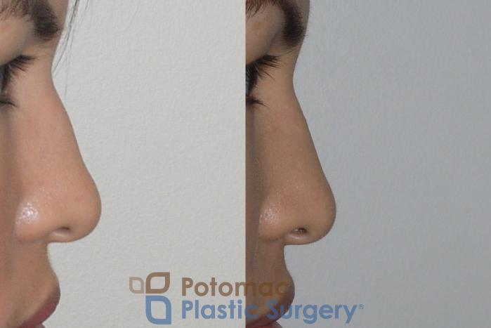 Before & After Rhinoplasty - Cosmetic Case 143 Right Side View in Washington DC & Arlington , DC