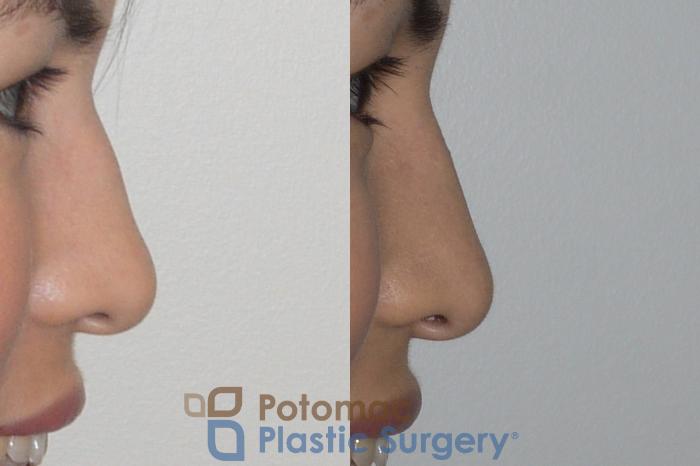 Before & After Rhinoplasty - Cosmetic Case 143 Right View #2 View in Washington DC & Arlington , DC