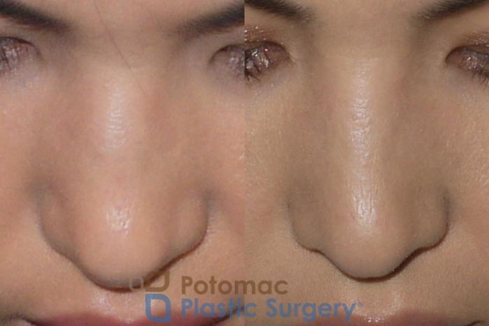 Before & After Rhinoplasty - Cosmetic Case 143 Top View in Washington DC & Arlington , DC