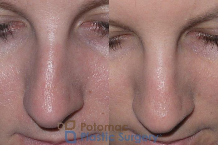 Before & After Rhinoplasty - Cosmetic Case 146 Above View in Washington DC & Arlington , DC