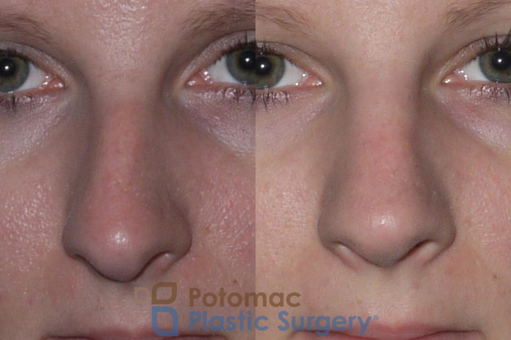 Before & After Rhinoplasty - Medical Case 146 Front View in Washington DC & Arlington , DC