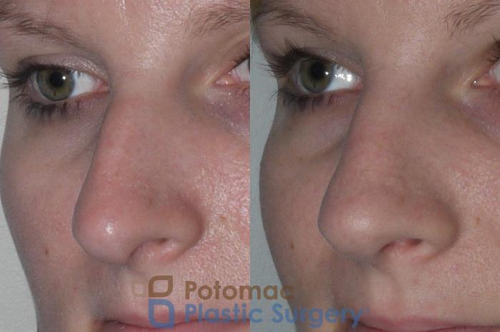 Before & After Rhinoplasty - Medical Case 146 Left Oblique View in Washington DC & Arlington , DC
