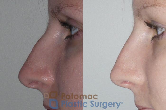 Before & After Rhinoplasty - Cosmetic Case 146 Left Side View in Washington DC & Arlington , DC