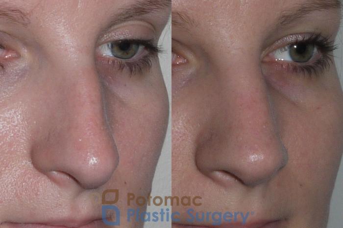 Before & After Rhinoplasty - Cosmetic Case 146 Right Oblique View in Washington DC & Arlington , DC