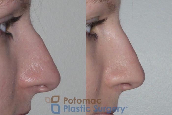 Before & After Rhinoplasty - Medical Case 146 Right Side View in Washington DC & Arlington , DC
