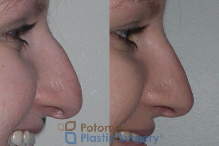 Before & After Rhinoplasty - Medical Case 146 Right Side View #2 View in Washington DC & Arlington , DC