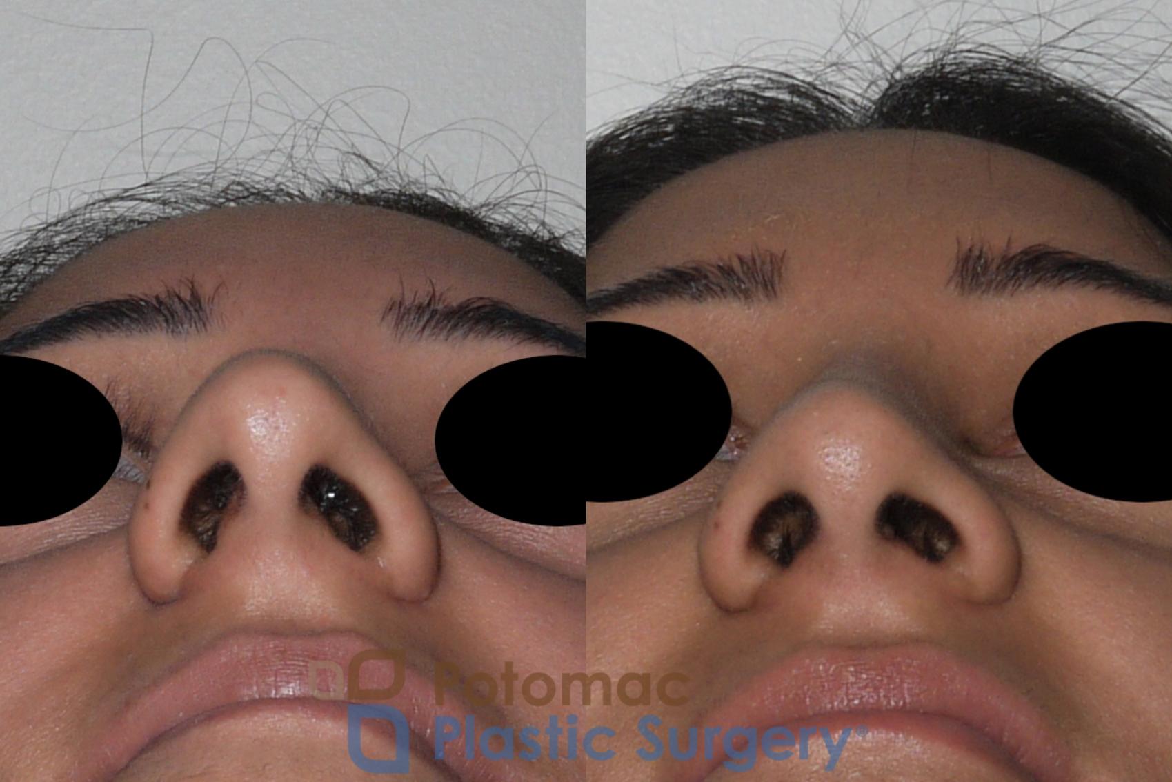 Before & After Rhinoplasty - Cosmetic Case 147 Below View in Washington DC & Arlington , DC