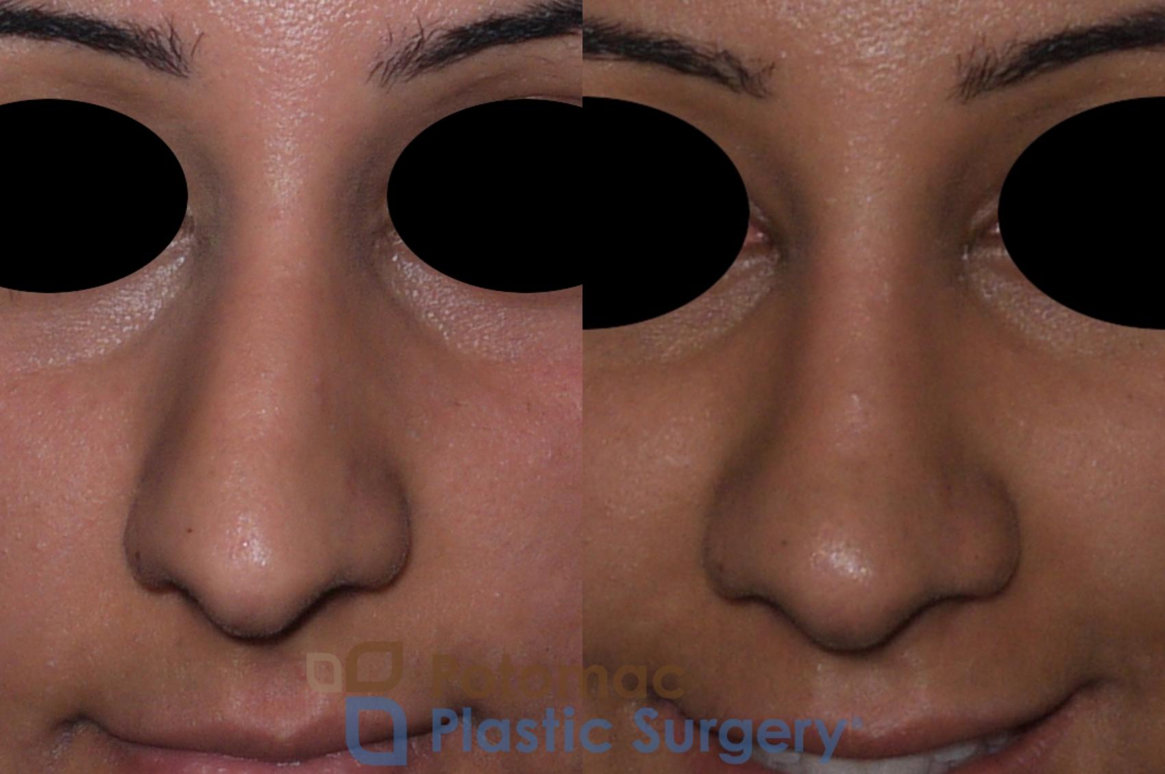 Before & After Rhinoplasty - Cosmetic Case 147 Front View in Washington, DC